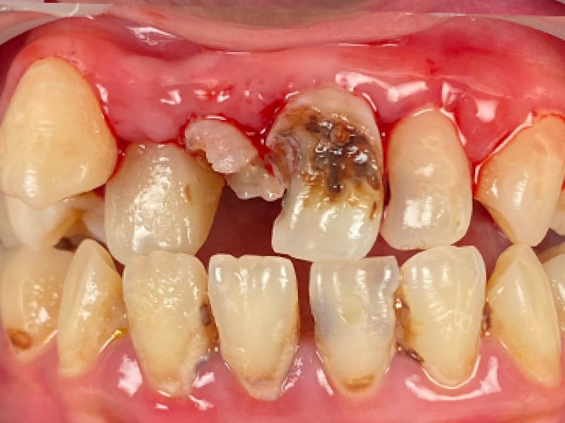 Direct Veneer - Maesa Dental Clinic | Klinik Gigi Terbaik