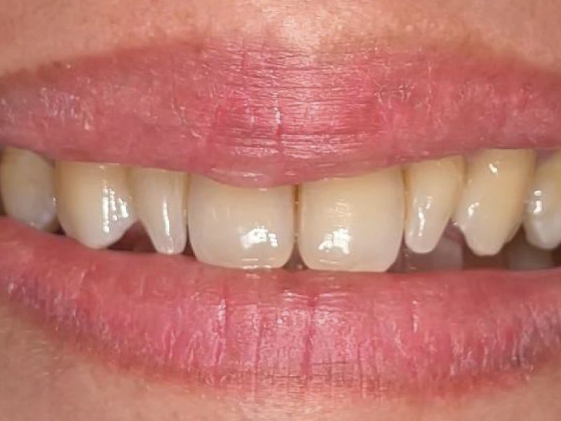 Inderect Veneer - Maesa Dental Clinic | Klinik Gigi Terbaik