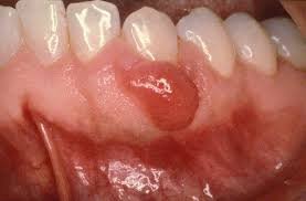 NEWS Maesa Dental Clinic | Klinik Gigi Terbaik - Tumor pada Ronga Mulut dengan Dentin. Apa Mungkin?