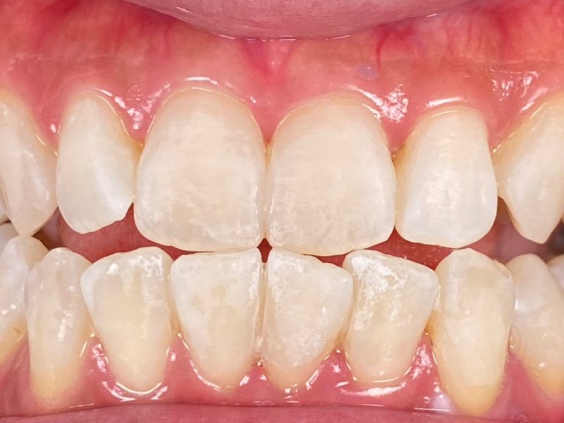 Bleaching Gigi - Maesa Dental Clinic | Klinik Gigi Terbaik