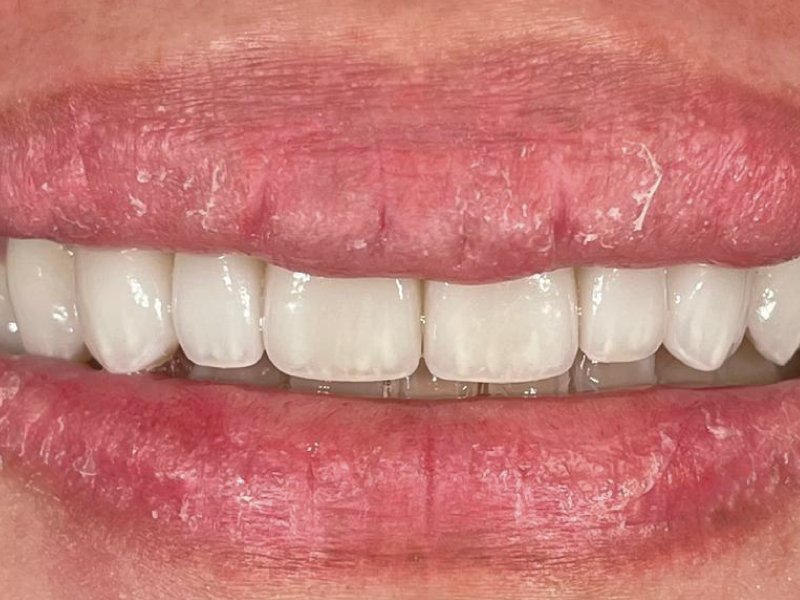 Inderect Veneer - Maesa Dental Clinic | Klinik Gigi Terbaik