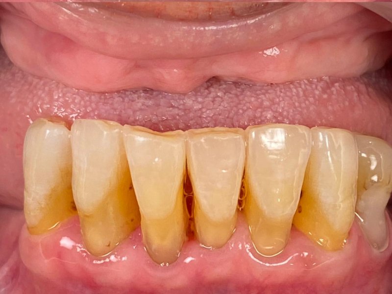 Gigi Palsu Lepasan - Maesa Dental Clinic | Klinik Gigi Terbaik