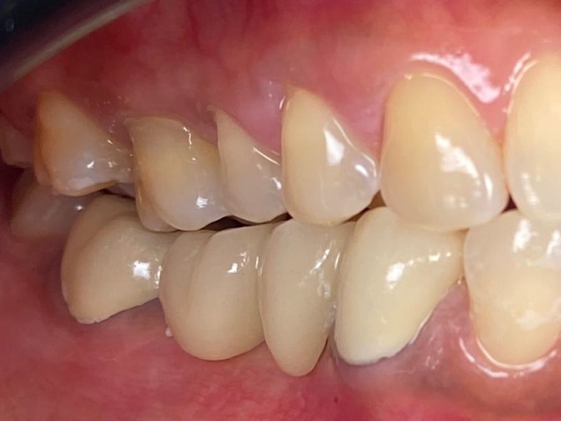 Gigi Palsu (PFM) - Maesa Dental Clinic | Klinik Gigi Terbaik