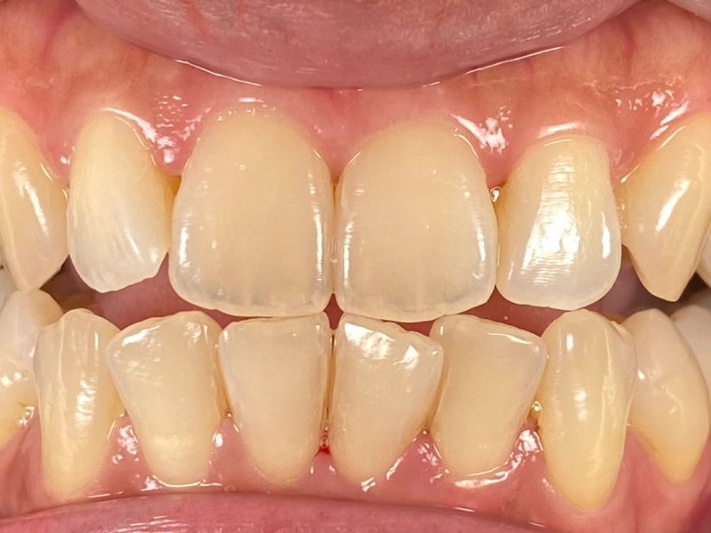 Bleaching Gigi - Maesa Dental Clinic | Klinik Gigi Terbaik