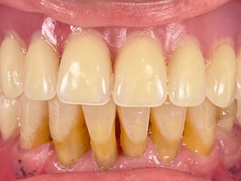 Gigi Palsu Lepasan - Maesa Dental Clinic | Klinik Gigi Terbaik
